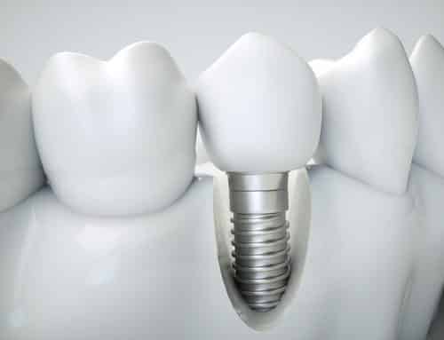 Impedida de entrar em banco com prótese dentária, cliente será indenizada 1 | Juristas Impedida de entrar em banco com prótese dentária, cliente será indenizada em 5 mil